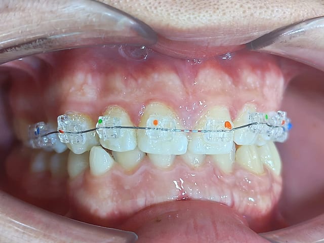 Caso real de ortodoncia con brackets