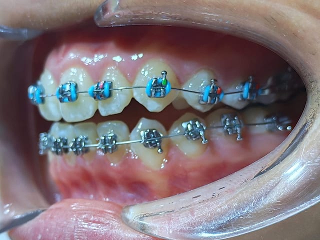 Caso real de ortodoncia con brackets