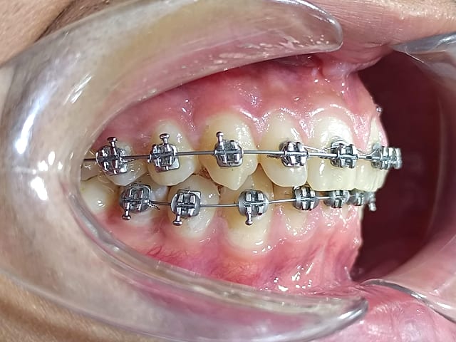 Caso real de ortodoncia con brackets